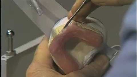 Construction of an Occlusal Bite Splint