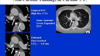 CCTA Training Video 9 Non Cardiac Non Vascular Findings