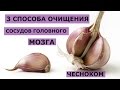 Что такое атеросклеротическая болезнь сосудов головного мозга, чем лечить
