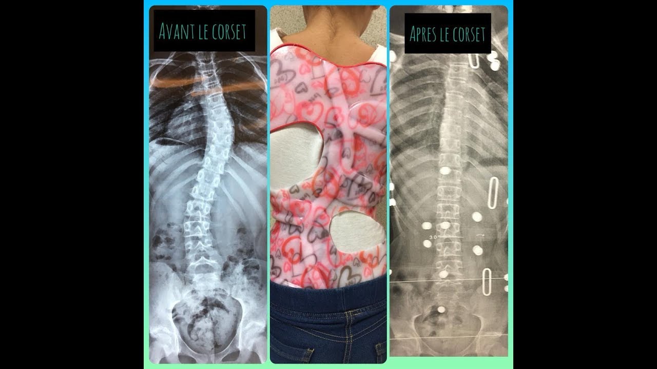 scoliose au maroc  medicpro صحتنا جميع : الأحد 24 مارس2019