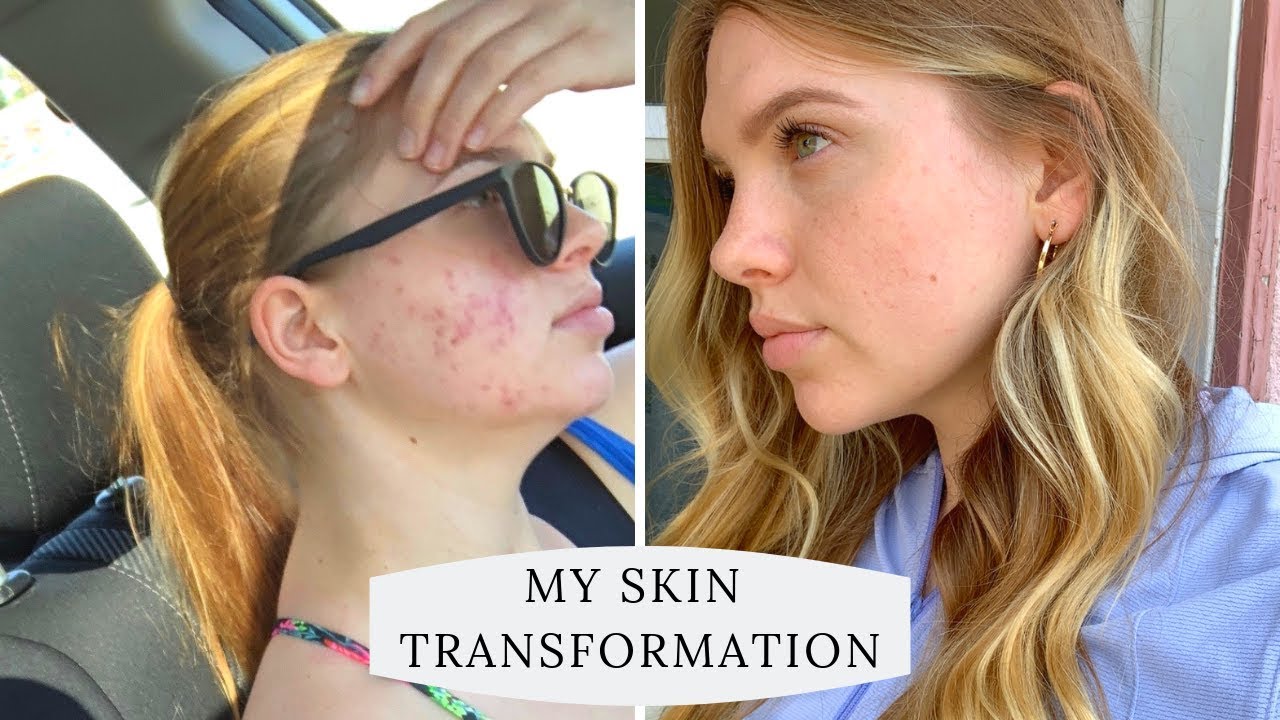 How I Got Rid Of My Cystic Acne | And 2019 Skin Regimen - YouTube