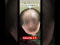 MINOXIDIL 5 18 DAY HAIRLOSS TREATMENT CALVIZIE Minoxidil Hairloss Calvizie Baldness 