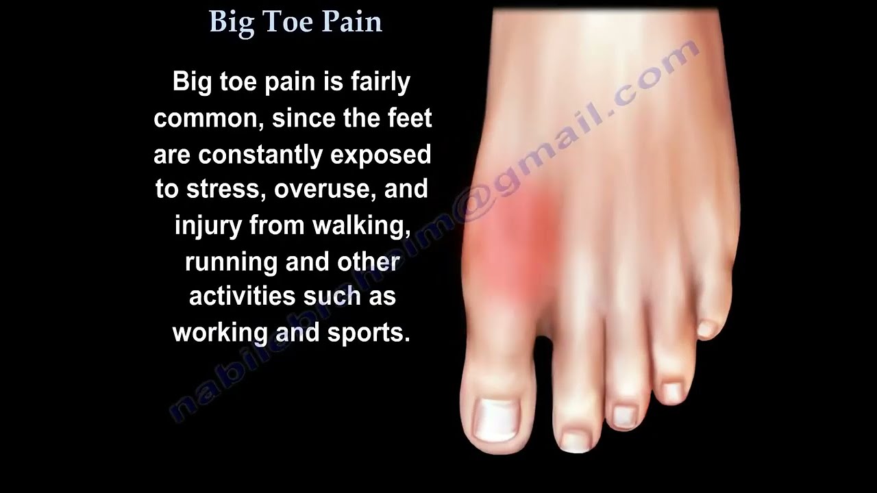 Big Toe Pain - Everything You Need To Know - Dr. Nabil Ebraheim 