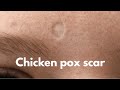 Micro scar revision surgery for chicken pox scar | Best scar treatment in Ranchi | Best scar surgeon