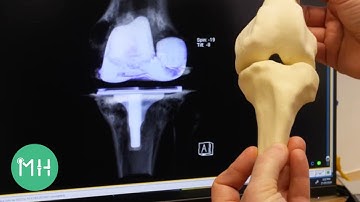 3D patient-specific knee replacement