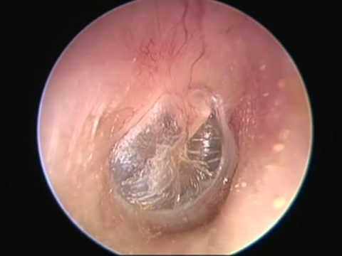 Patulous Eustachian Tube Causing Hypermobile Eardrums