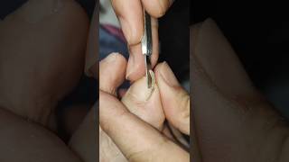 Ingrown toenail - Fungus treatment - Toenail cleaning - Pedicure 012