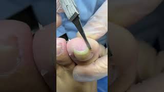 Satisfying nail cleaning process#nailcare #pedicure #satisfying #nailtech #oddlysatisfying #fyp