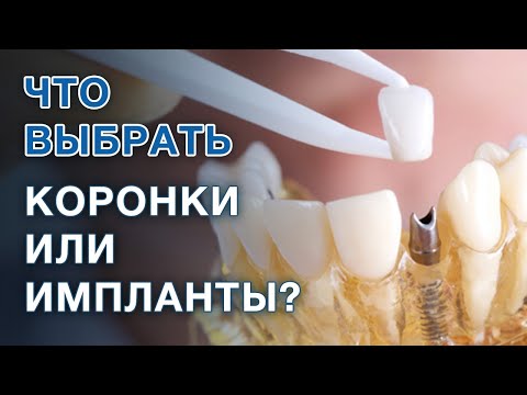 Коронки или имплант: что лучше выбрать? / Если зуб разрушен, удалять и ставить имплант или коронку?