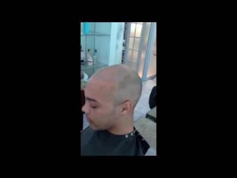Video thumbnail: Alopecia Treatment | Hairloss Treatment Solution | Hairsimulation for Hair Loss- Update Mr. CR