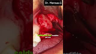 extraction d'une dent de sagesse maxillaire incluse