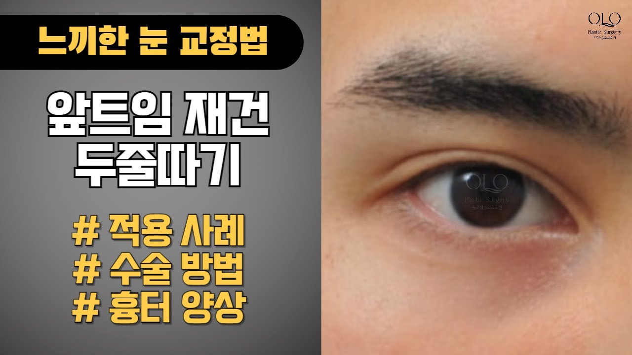 [ОЛЛО гоо сайхны мэс заслын эмнэлэг] Хэт хиймэл эсвэл хүнд харагдах нүднээсээ санаа зовж байна уу? ОЛЛО-д #СанааЗоволт #СанааЗовохоосУрагшил #НүднийДахинМэсЗасал хийлгэхийн өмнө заавал үзэх ёстой бичлэг