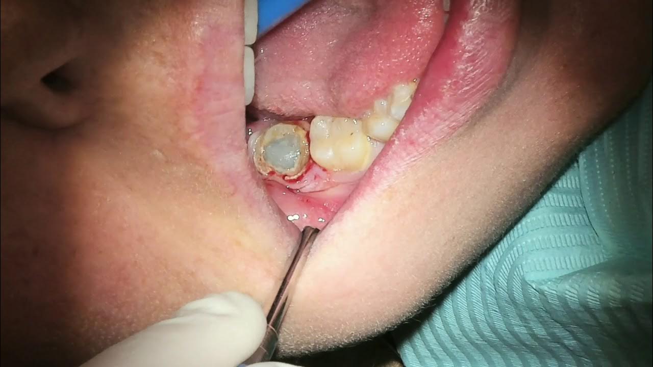 Can An Infected Wisdom Tooth Cause A Sore Throat