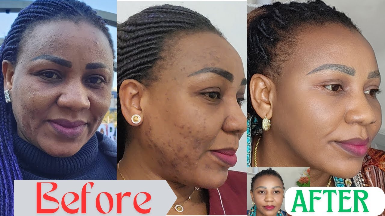 How I Got Rid of My Acne *1 products that changed my life* | My Skin ...