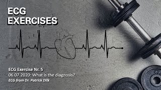 ECG Exercise Nr. 5: an irregular supraventricular atrial tachycardia.