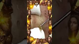 Blackheads Removal | Acne Treatment and Very Satisfying Satisfying Pimple pop blackheads