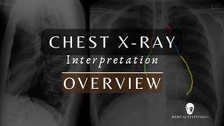 How to Read Chest X-Rays (CXR) | ABCDEF Method Explained for Beginners #xray