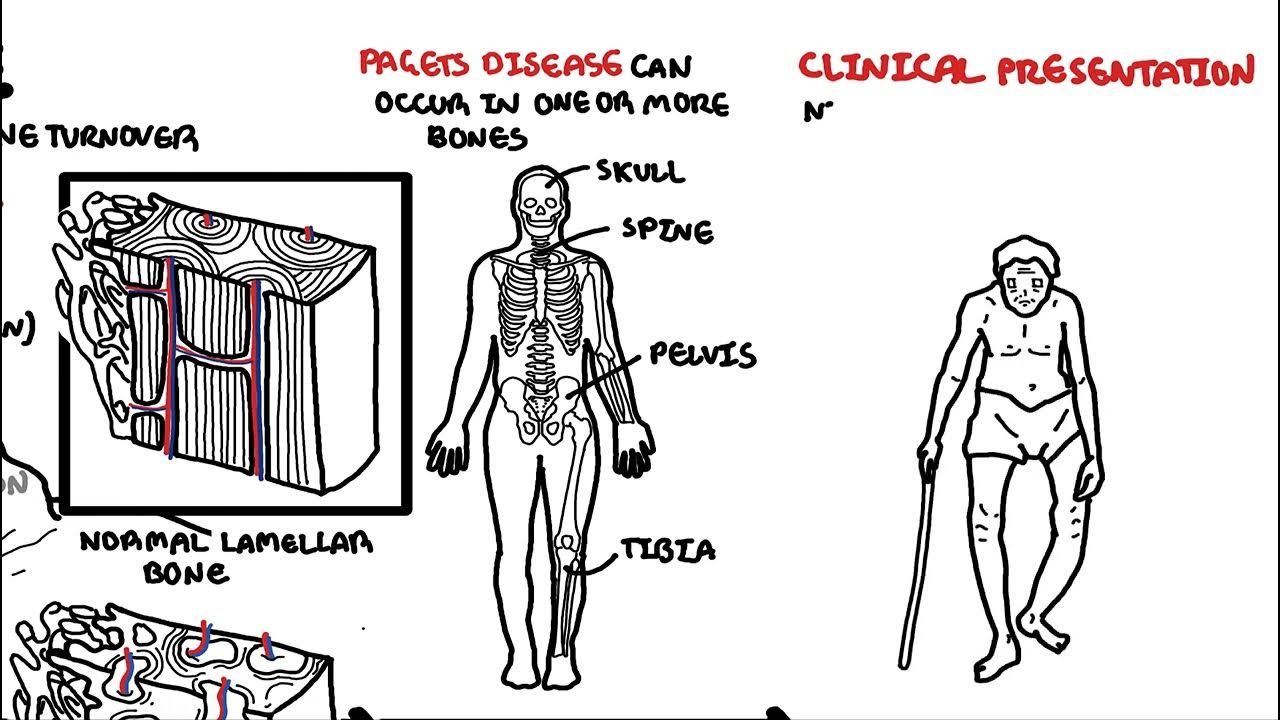 Paget's Disease of the bone YouTube