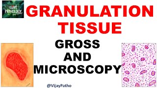 GRANULATION TISSUE  |  Pathology |  Gross and Microscopy  |   Illustration | Draw With Me!