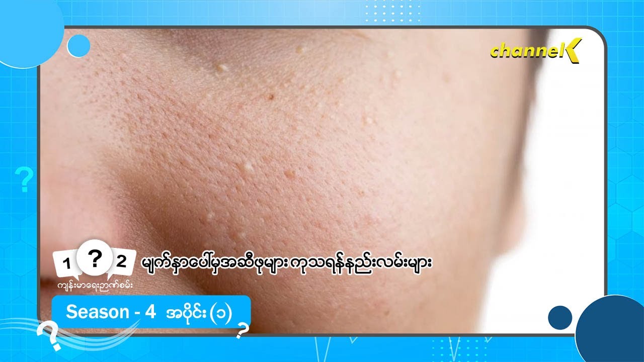 ကျန်းမာရေးဉာဏ်စမ်း (Season 4) - အပိုင်း(၁) မျက်နှာပေါ်မှအဆီဖုများ ကုသရန်နည်းလမ်းများ