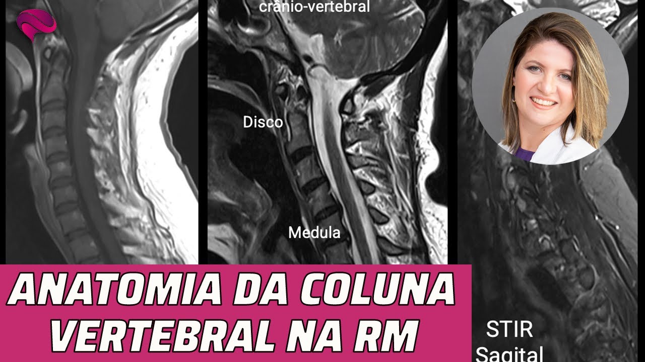 ANATOMIA DA COLUNA VERTEBRAL NA RESSONÂNCIA MAGNÉTICA