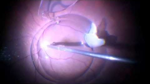 Vitrectomy for removal of dislocated IOL and lens matter | Dr Manish Nagpal
