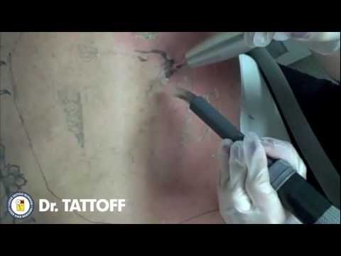 ... Laser Tattoo Removal at Dr. TATTOFF Santa Ana, Orange County - YouTube
