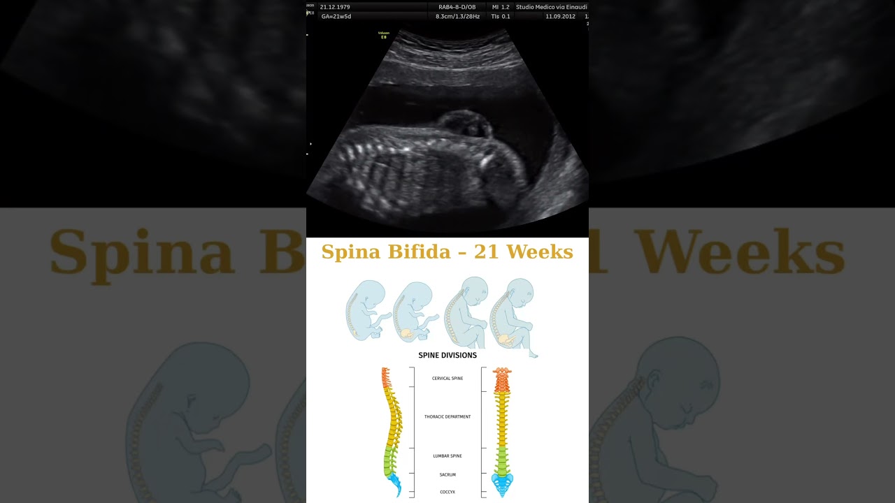21 Weeks Pregnant – Fetal Ultrasound Showing Spina Bifida 