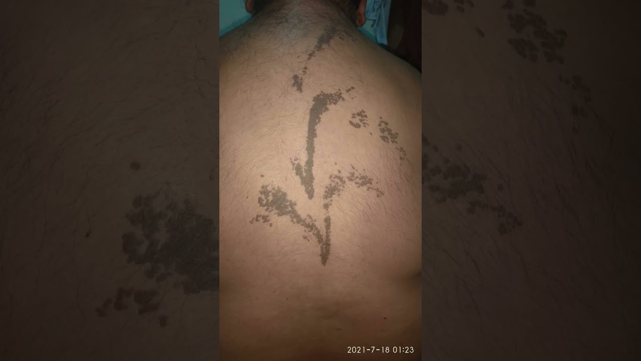 amazing birthmark in the world.none of the person have this type of birth mark