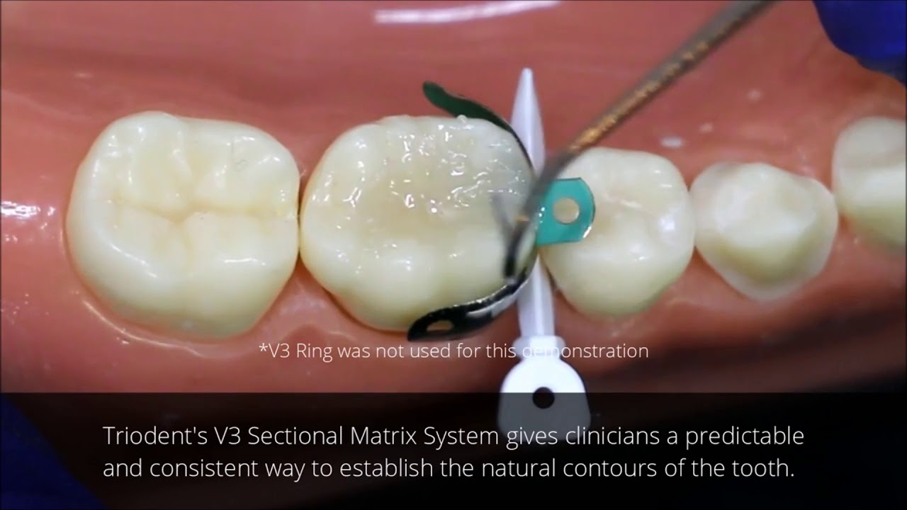 Amalgam vs Composite V3 Tofflemire Solution - YouTube