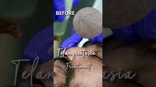 Worried About Telangiectasias? Dr. Priyanka Reddy Dna Skin Clinic