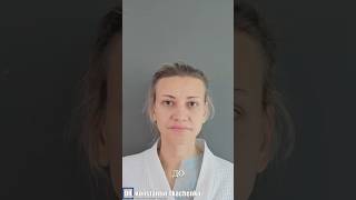 До и 1 год после ринопластики. Отеки к этому времени сходят и мы уже можем оценить результат.