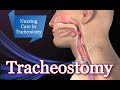 Tracheostomy [ Procedure, Suctioning & Nursing Care ]