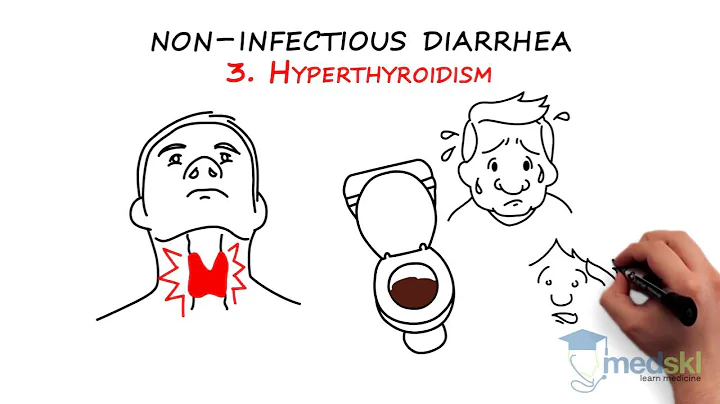 Gastroenterology - Acute Diarrhea: By John Kargbo M.D.