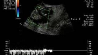 ultrasound 29/05/07 13w 10:45