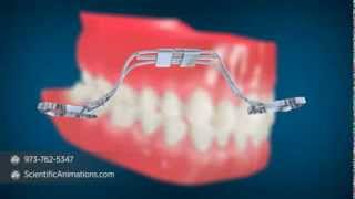 Rapid Palatal Expansion - Dental Implant Procedure