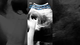 Bicrounut uterus with Right horn early pregnancy with left horn empty in ultrasound views.