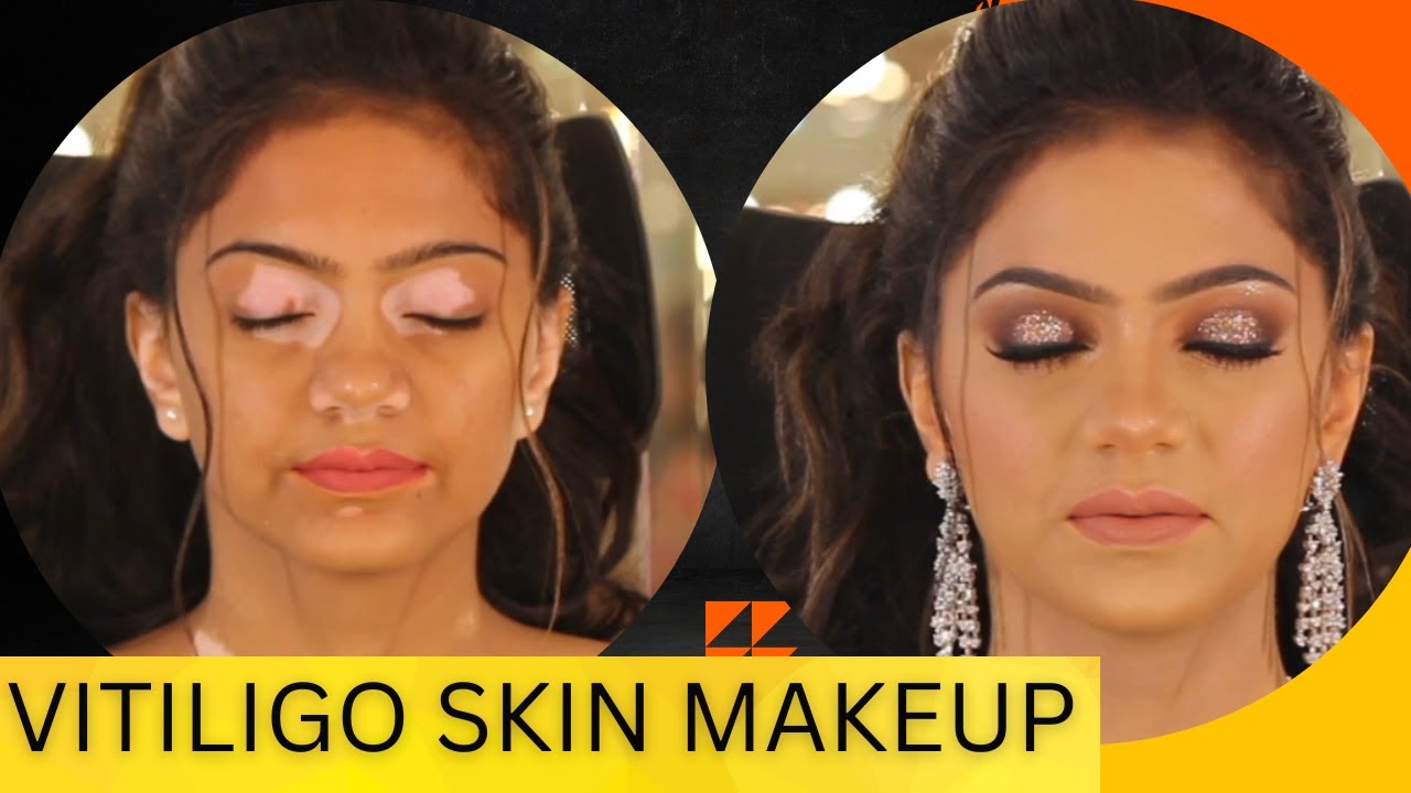 How To Er Vitiligo In Makeup Easy