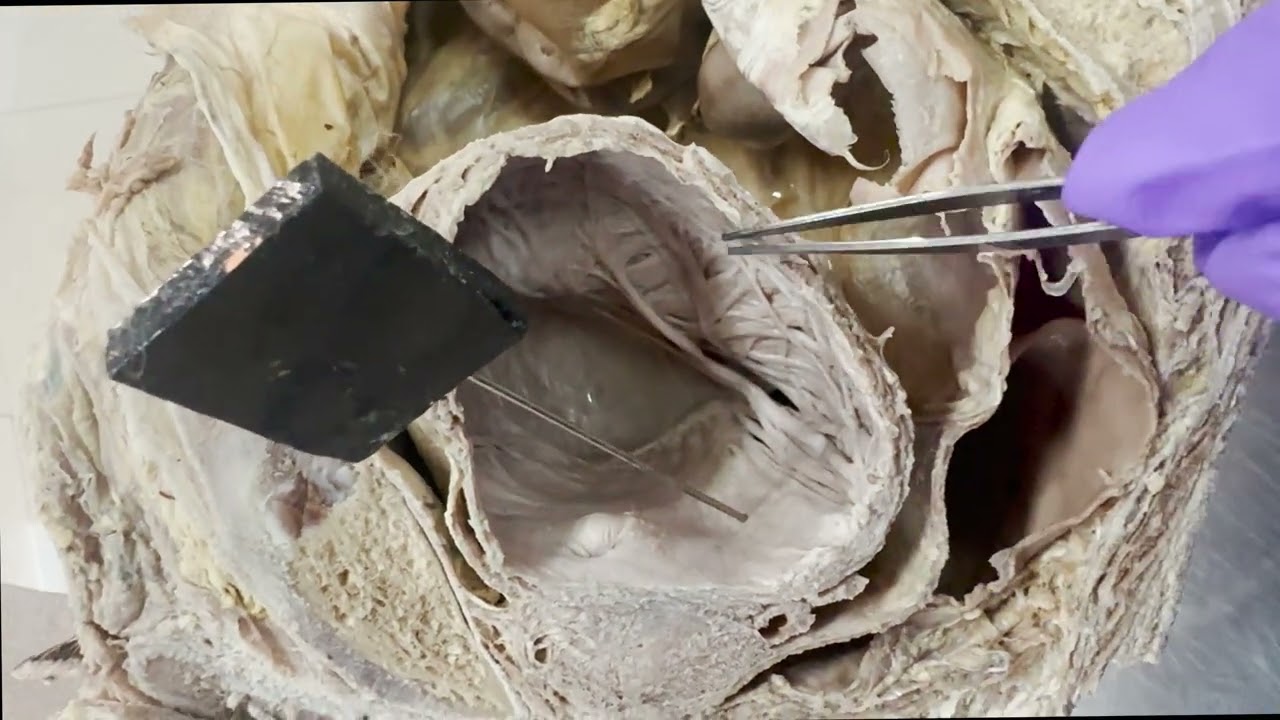 Trigone of Urinary bladder 1