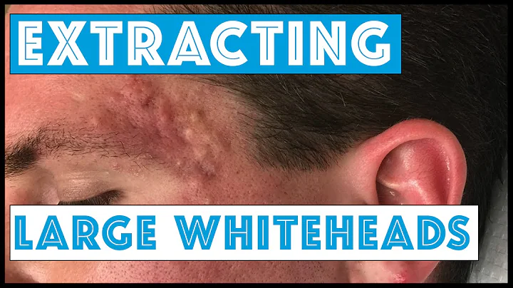 Acne Vulgaris and Extracting large Whiteheads - Pa...