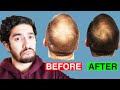 Is PRP a MIRACLE Cure for Hair Loss?