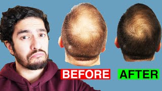 Is PRP a MIRACLE Cure for Hair Loss?