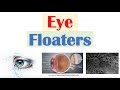 Eye Floaters (Vitreous Floaters) | Causes, Risk Factors, Associated Conditions, Diagnosis, Treatment