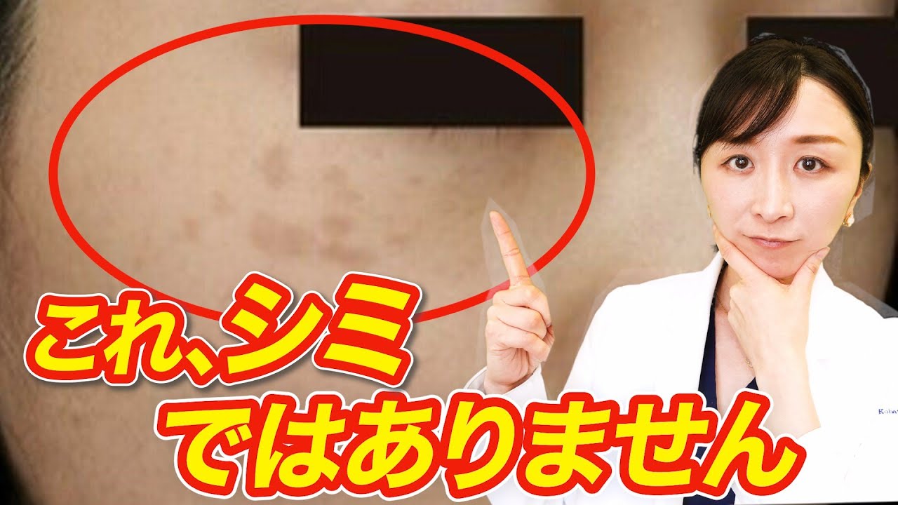 【これはシミではありません】これの正体について皮膚科医が詳しく解説！