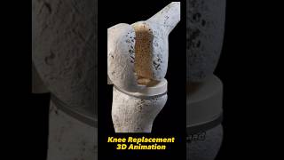Knee Replacement 3D Animation