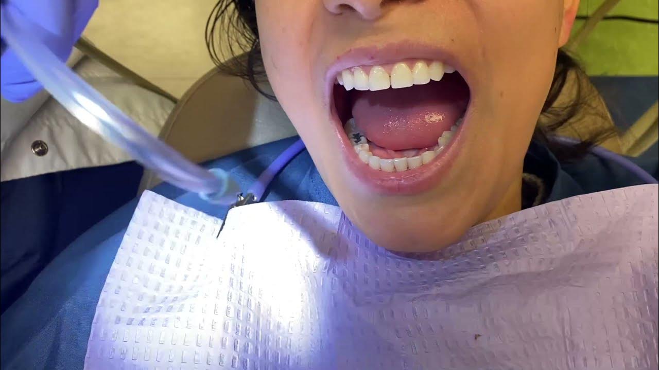 Dental Cleaning (prophylaxis) Hand Scaling + Cavitron and Polish