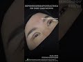 Operatsiya 98🔥 2026 #nodirbakhodirov #doctor #blefaroplastika #shorts #shortvideo #onthisday