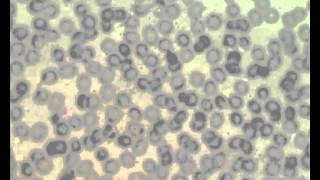 Mixed infection of 3 Plasmodium species  using webscope for recording VDO