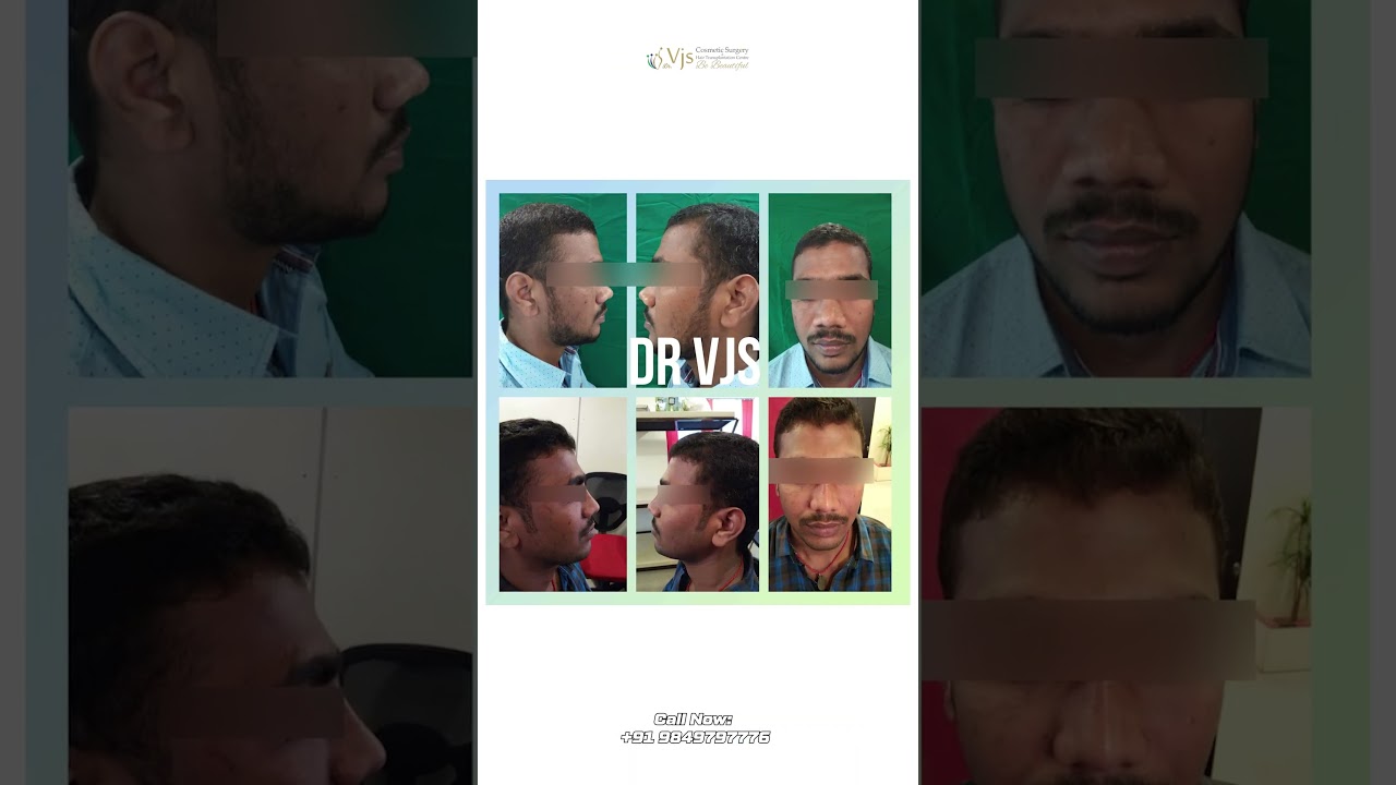 Hiding Your Side Profile? | Nose Correction Surgery in Vizag | See What Changed Her Confidence