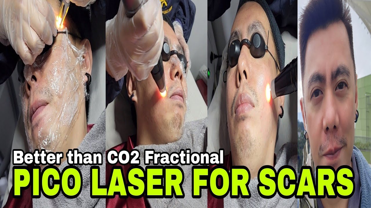 BETTER THAN CO2 FRACTIONAL 1ST Pico Laser Treatment For Acne Scars Sa BETTER THAN CO2 FRACTIONAL 1ST Pico Laser Treatment For Acne Scars Sa